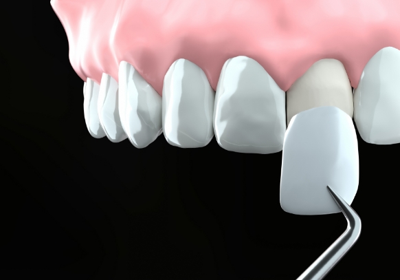 ラミネートべニア