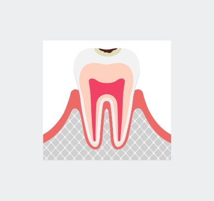 エナメル質の虫歯