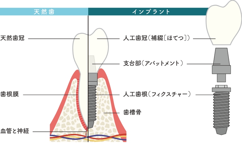 インプラントの仕組み