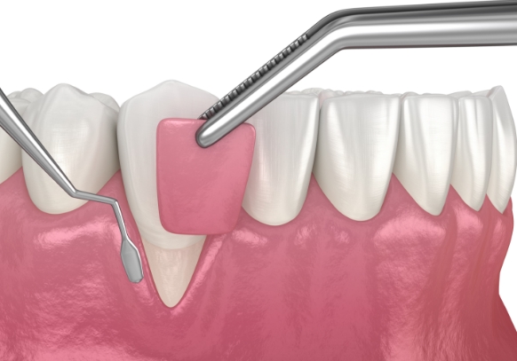2.歯ぐきの移植手術