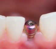 インプラント治療