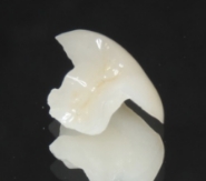 セラミックインレー