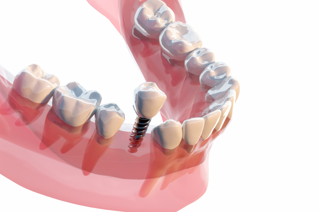 もう悩まない！失った歯を取り戻す、インプラントの基本知識