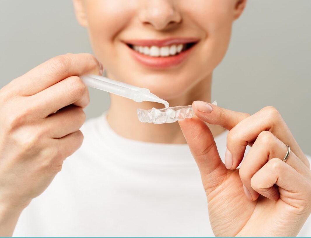 自宅でできるホワイトニングの注意点🦷✨