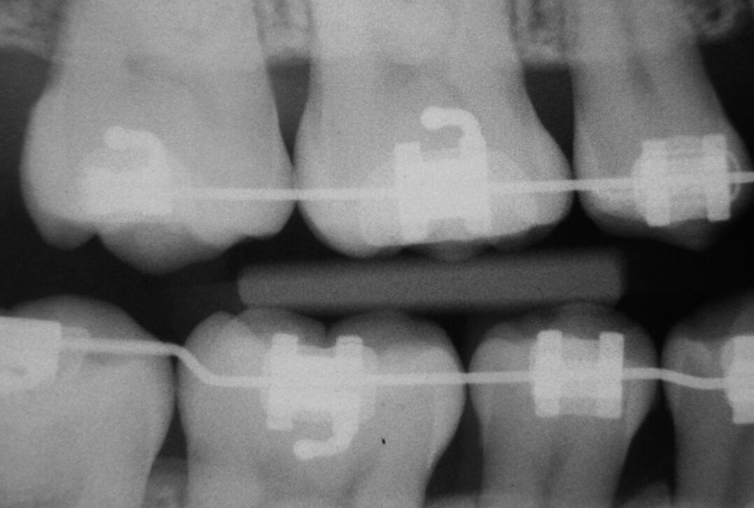 🦷部分矯正という選択肢もあります！
