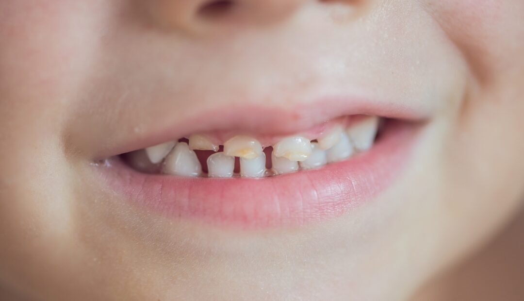 乳歯が抜けないとどうなる？🦷今チェックしたい、お子さんの歯の“生え変わり”事情🪥