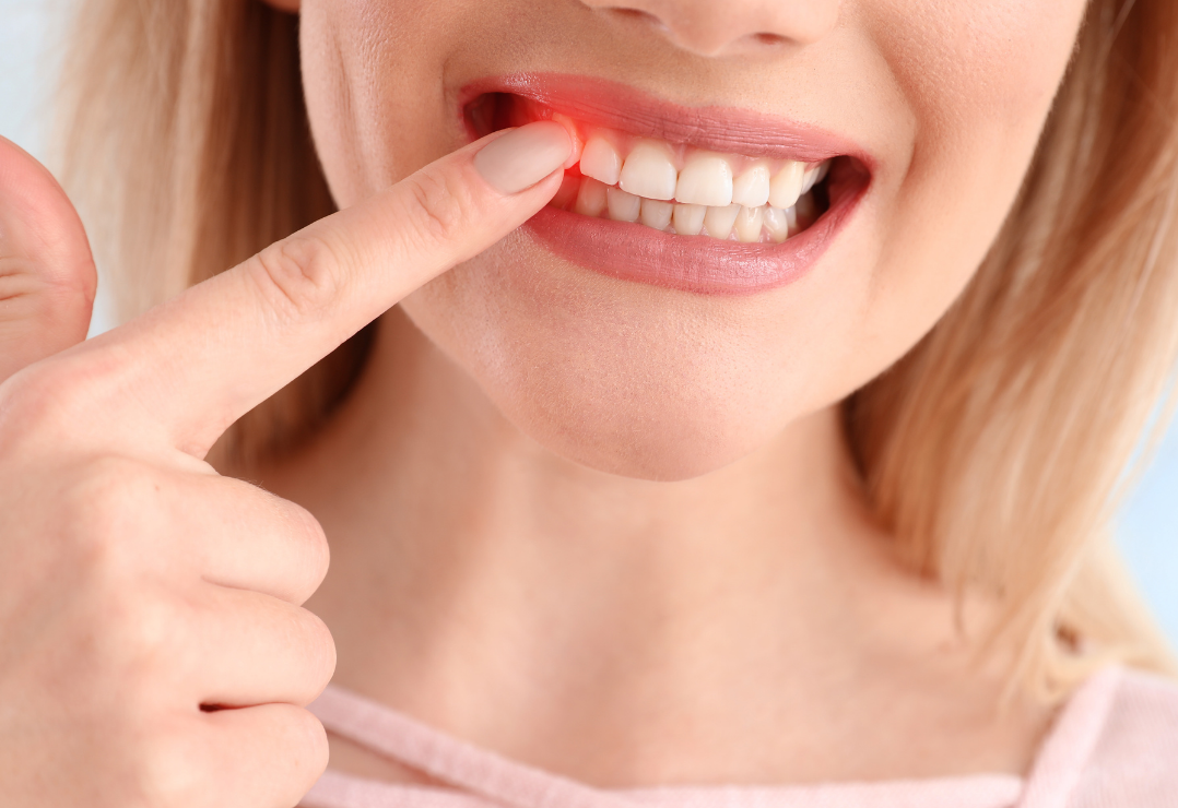 進行する前に！中度の歯周病治療とは🪥