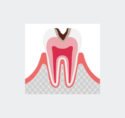 象牙質まで侵されている虫歯