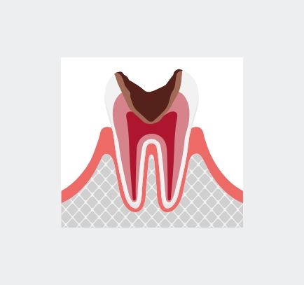 歯髄まで侵されている虫歯