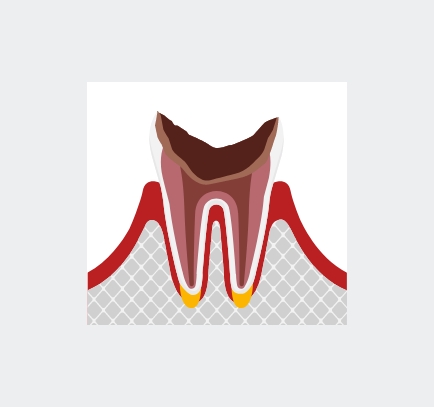 歯根部まで侵されている虫歯