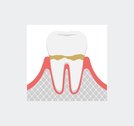2.歯肉炎（歯周病の始まり）